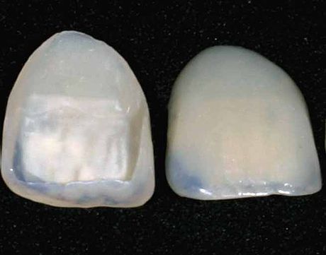 A Veneer
