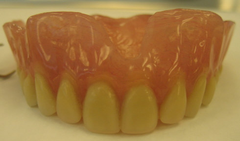 A type of Denture