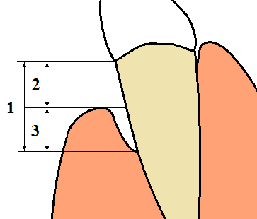 Total loss of attachment