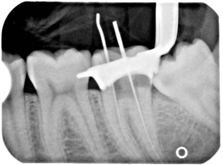 Xray of a Root Canal Operation