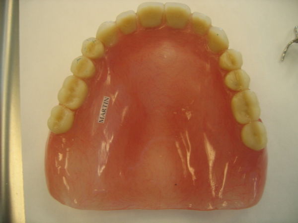 Occlusal View of Denture
