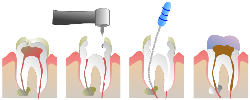 Root Canal procedure